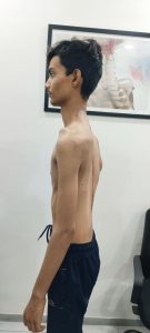 Side view of teenage boy with scoliosis spine condition